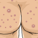 Illustration for article titled Do You Have Buttne (Acne on Your Butt)?